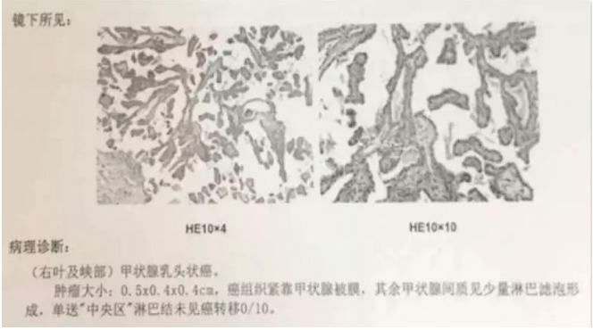 別慌，甲狀腺疾病還可以這樣投保！